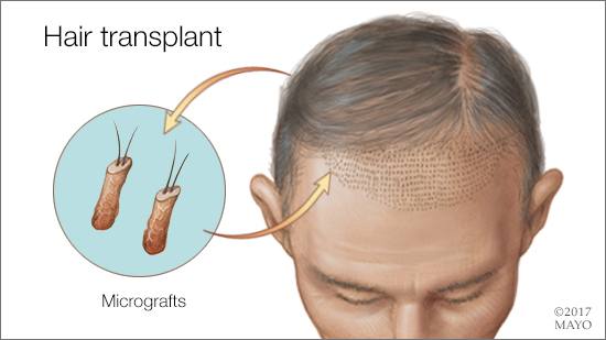 Para no vivir sin cabello:  Todo lo que debes saber sobre el trasplante capilar
