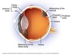 El melanoma que aparece en el ojo generalmente se puede tratar con radioterapia